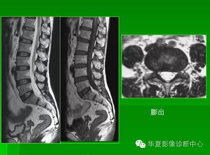 腰间盘窍出怎么办？从原因到治疗的全面解析