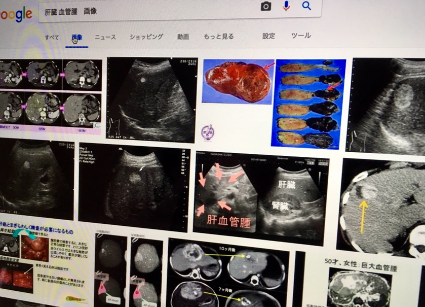 肝上有血管瘤怎么办？全面解析肝血管瘤的诊断、治疗及预后