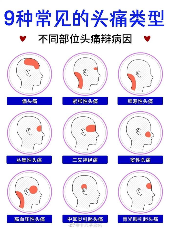 偏头痛是怎么回事？深度解析偏头痛的成因、症状和治疗方法