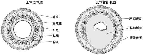 支气管扩张怎么治疗才能除根？深度解析治愈方法及挑战