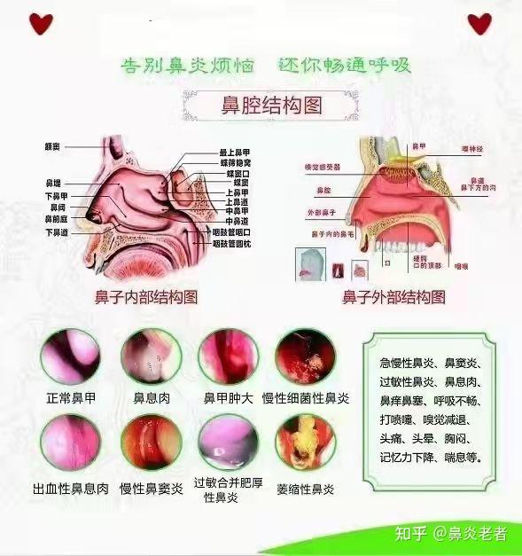 鼻甲肥大怎么治最好？权威解读及治疗方案全解析