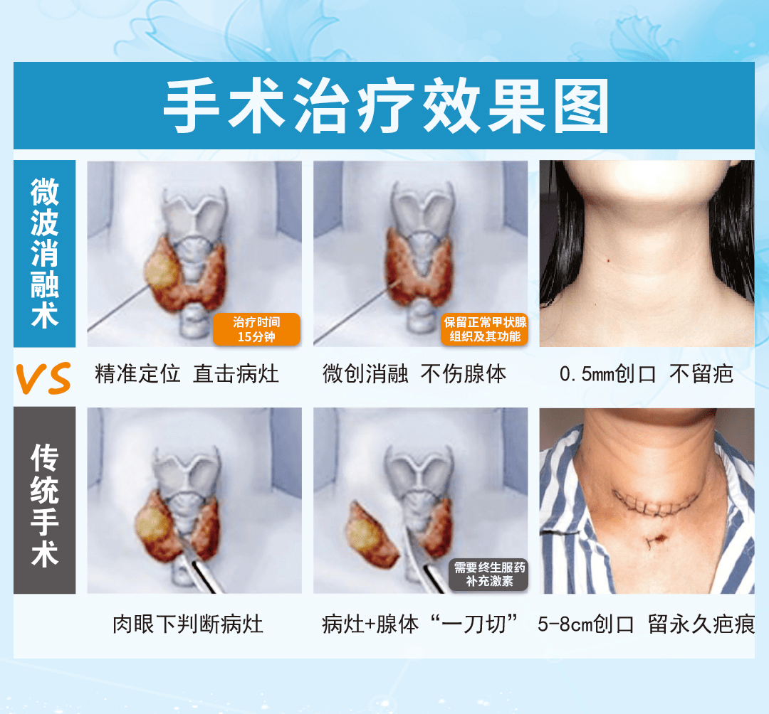 脖子上有肿块是怎么回事？淋巴结肿大、甲状腺结节等常见原因深度解析