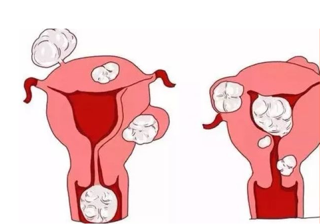 子宫肌瘤的诊疗策略：有子宫肌瘤怎么办？