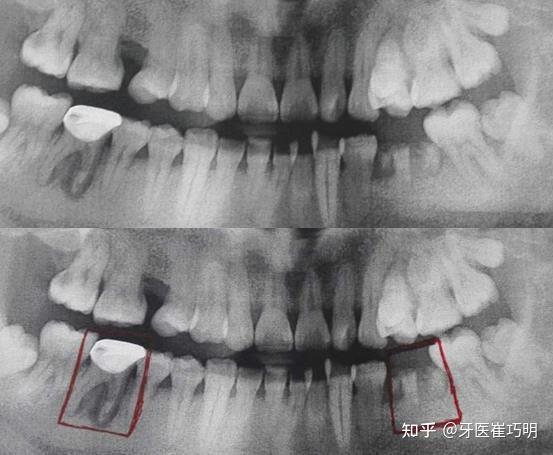 牙髓怎么治疗？深度解析牙髓疾病的诊疗方案及未来趋势