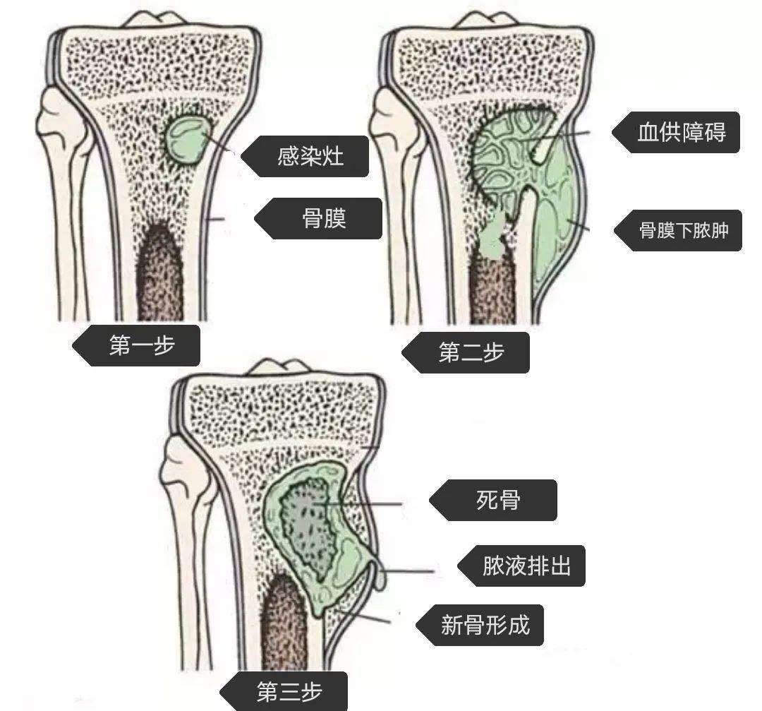 骨髓炎怎么治疗最好？深度解析骨髓炎治疗方案及康复策略