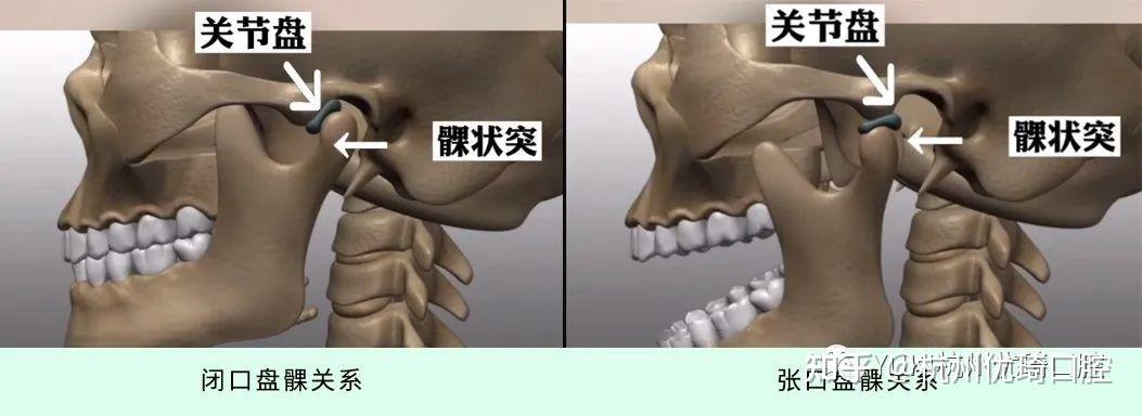 下颌骨错位怎么矫正？权威解读及治疗方法全解析