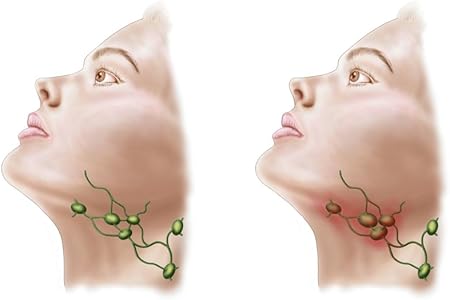 淋巴肿大是怎么引起的？探究淋巴系统疾病的病因与防治