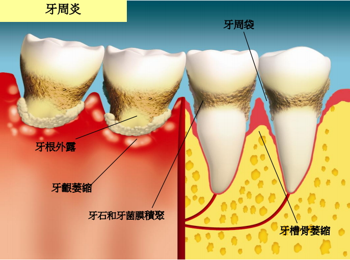 牙龈萎缩怎么调理？深度解析及有效应对策略