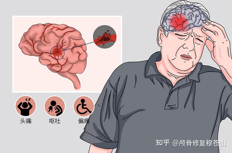 脑出血怎么治疗？深度解析治疗方法、风险及未来趋势