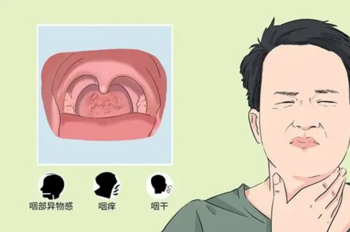 咽炎是怎么引起的？深度解析咽炎病因及预防措施