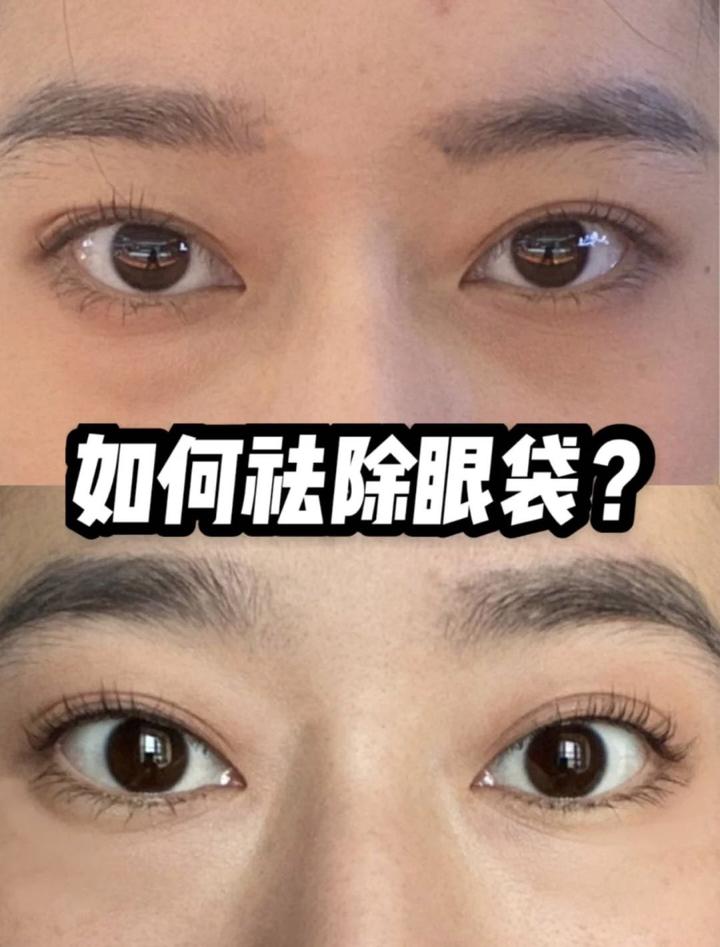 眼袋淤青怎么快速恢复？权威指南助你重拾明亮双眸