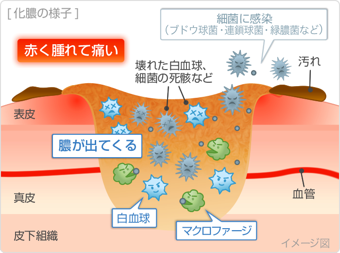 伤口化脓了怎么办？全面解析化脓伤口处理及预防