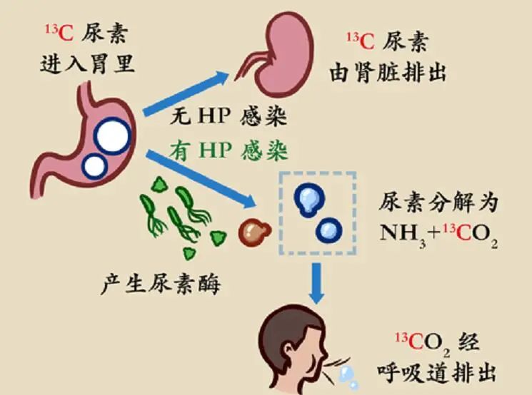 幽门螺杆菌感染如何治疗？最新疗法及注意事项详解