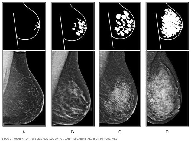 乳房硬块怎么办？全面解读乳房硬块成因、自查方法及就医指南