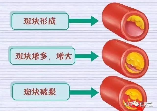 尿毒症怎么形成的？深度解析慢性肾脏病致尿毒症的机制