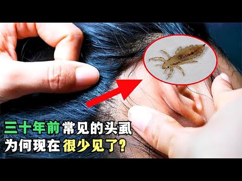 头上长虱子怎么办？有效防治及护理指南