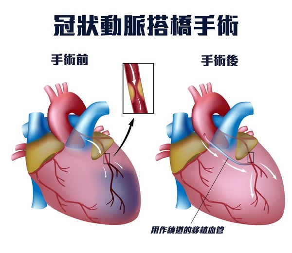 冠状动脉堵塞怎么治疗？深度解析治疗方案及风险