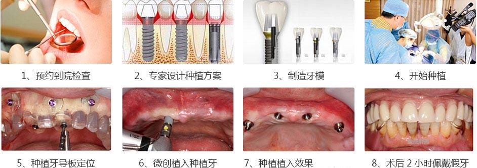 牙齿种植全攻略：从手术流程到术后护理，帮你解答所有疑问