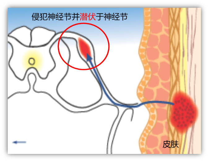 带状疱疹怎么引起的原因：病毒潜伏与免疫力下降的博弈