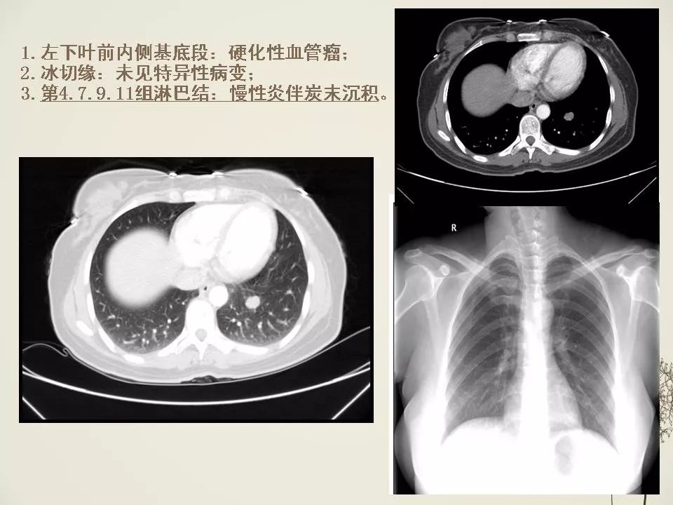 肺节结怎么治疗？深度解析肺节结的诊断、治疗及预防