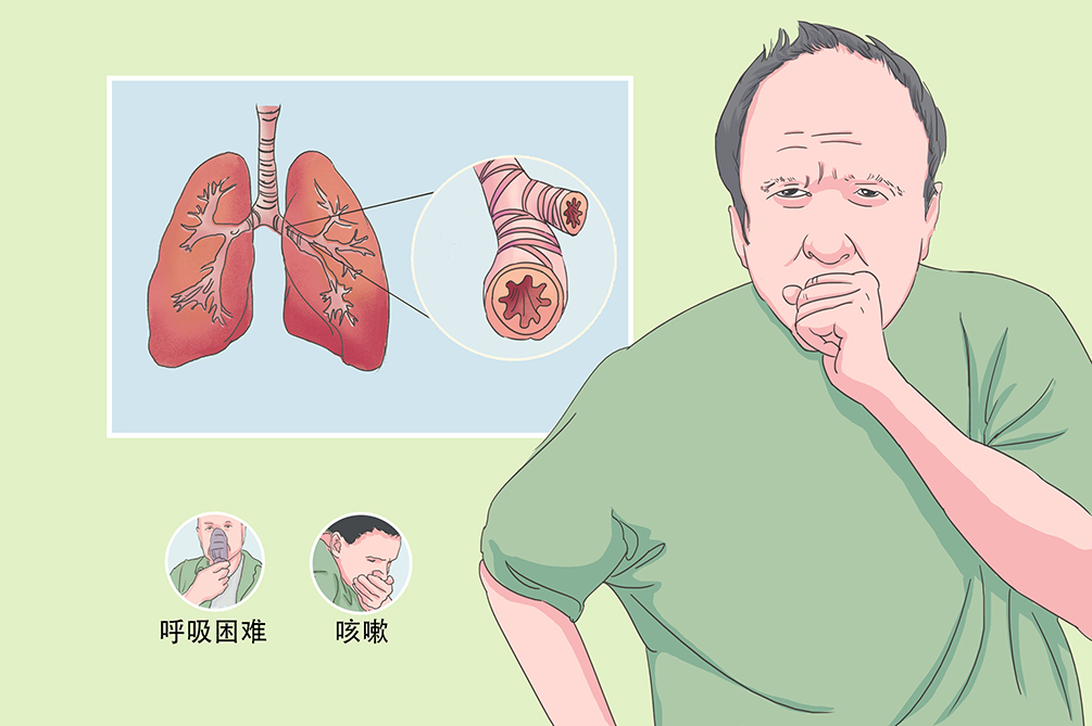 气管有哮鸣音怎么办？探究原因及有效应对策略