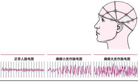 脑电图异常是怎么回事？深度解析脑电图异常的成因、诊断及治疗