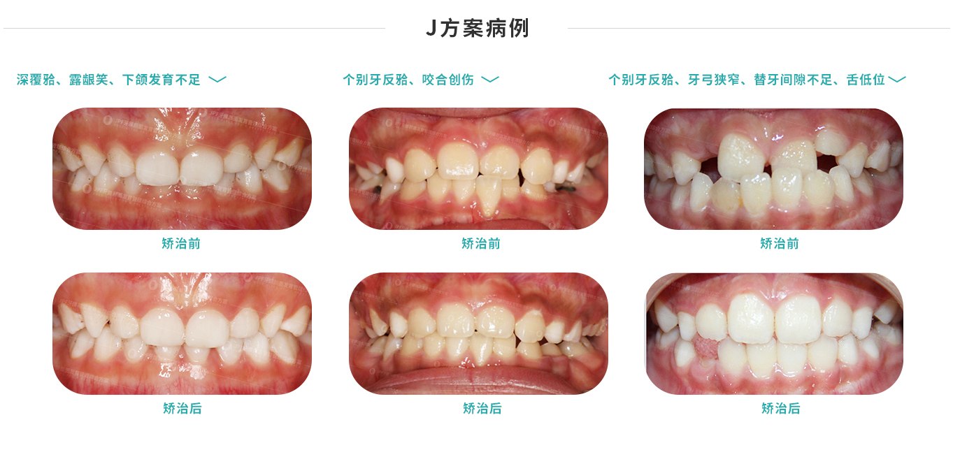 怎么治疗早进？从原因到方法的全面分析