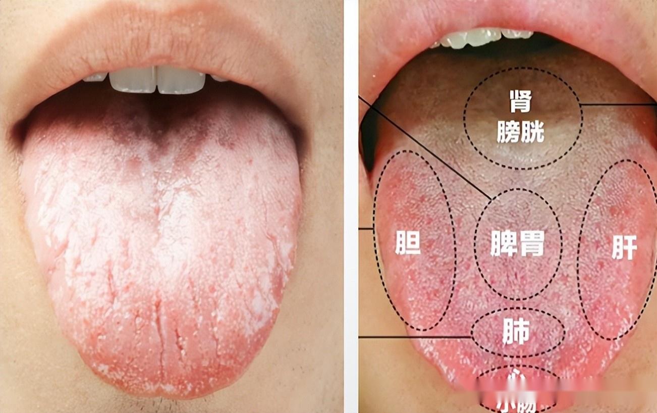 舌苔厚白怎么回事？中医解读及现代医学分析