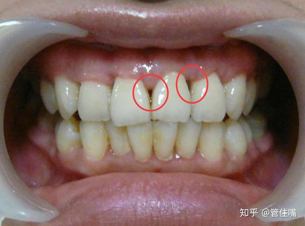 牙龈萎缩该怎么办？深度解析及应对策略