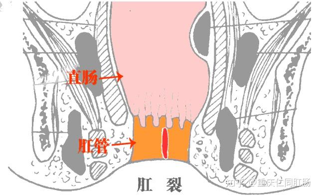 怎么辨别是痔疮出血还是便血？肛肠疾病鉴别诊断指南