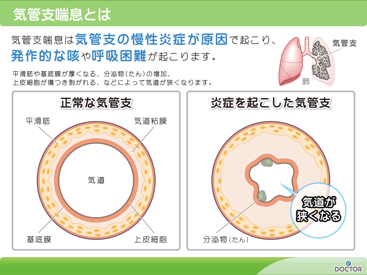 支气管炎咳嗽怎么治？深度解析治疗方法及护理要点