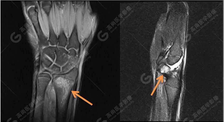 骨髓水肿是怎么回事？详解病因、症状及治疗方法