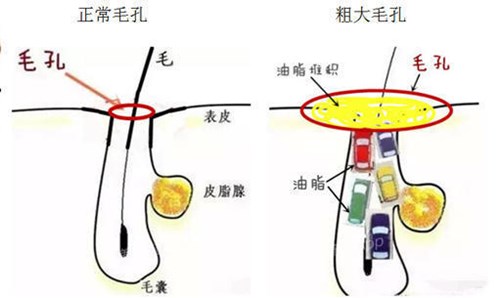 粉刺是怎么形成的？深入剖析毛孔堵塞的奥秘及应对策略