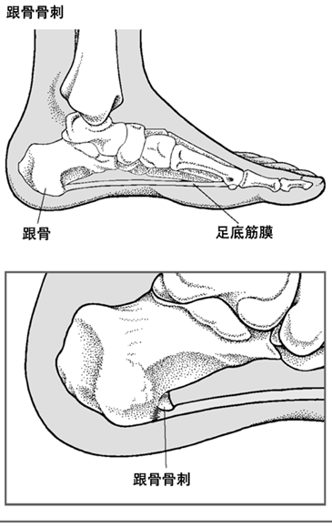 足跟骨刺怎么治疗能根除？深度解析治疗方法及有效预防