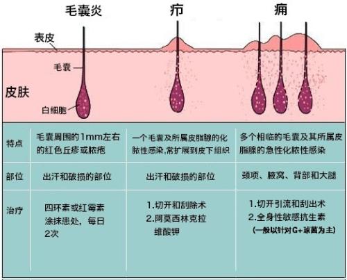 毛囊炎疙瘩怎么消除？深度解析及有效应对策略