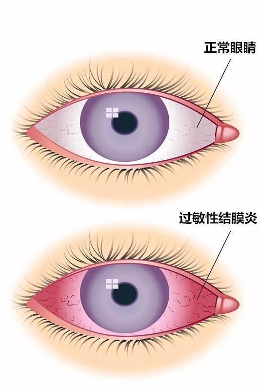 结膜炎怎么治疗？详解各种类型结膜炎的治疗方法及预防措施