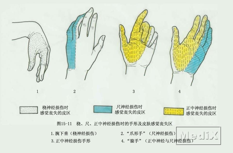 右手无名指麻木是怎么回事？神经卡压、腕管综合征等多种原因深度解析