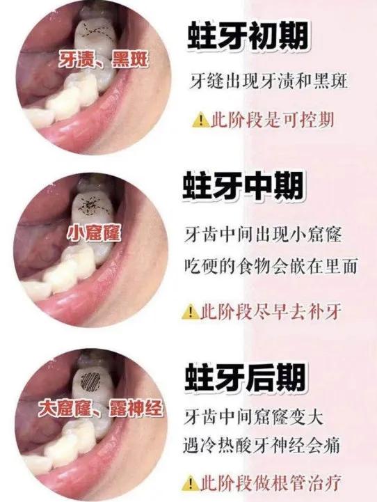 有虫牙怎么办？详解虫牙治疗及预防方法，助您拥有健康牙齿