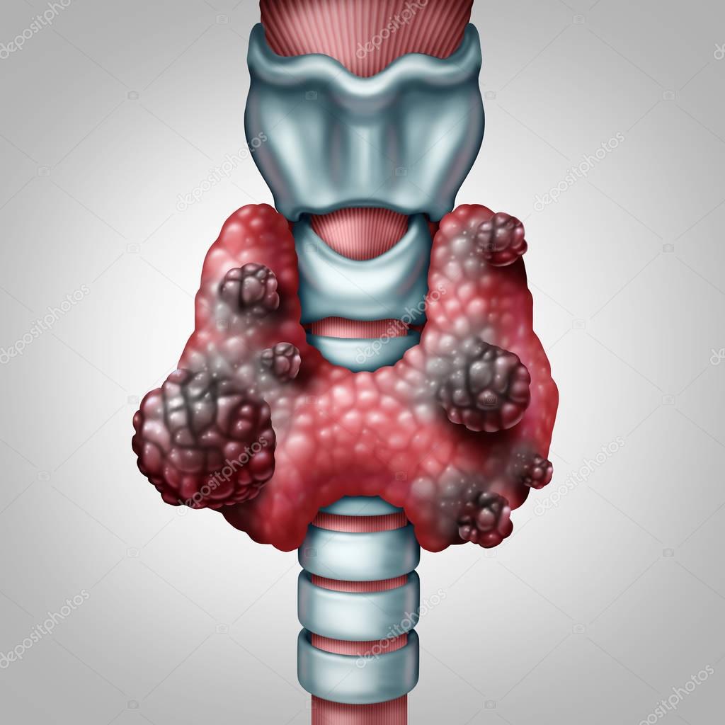 甲状腺囊性结节是怎么回事？深度解析及应对策略