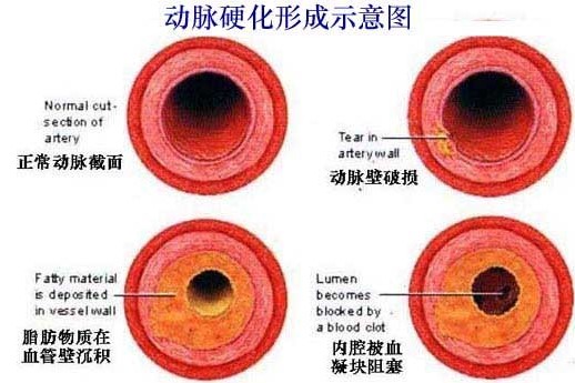 血生动脉硬化是怎么事？从病原、症状到预防治疗全面解释