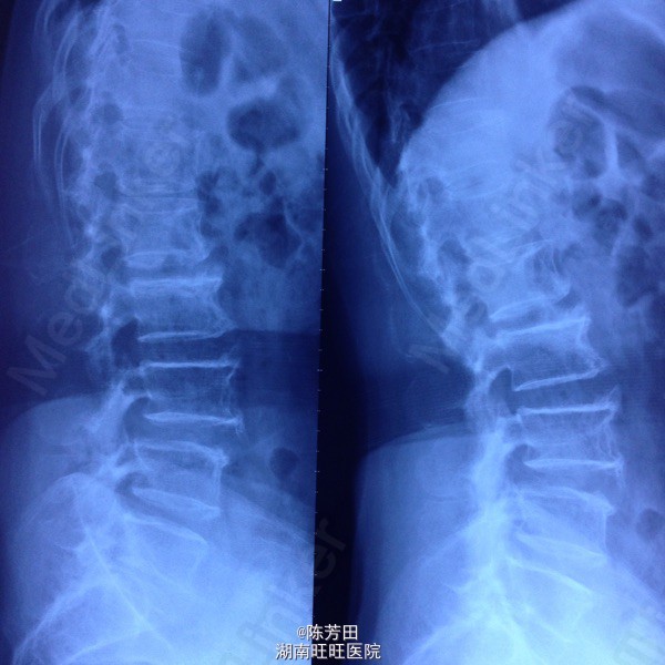 腰椎最新研究：从微创手术到基因疗法，探寻脊柱健康新未来