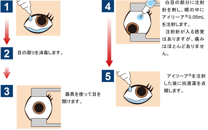 眼睛黄斑病变治疗最有效最新方法：多维视角解读与未来展望