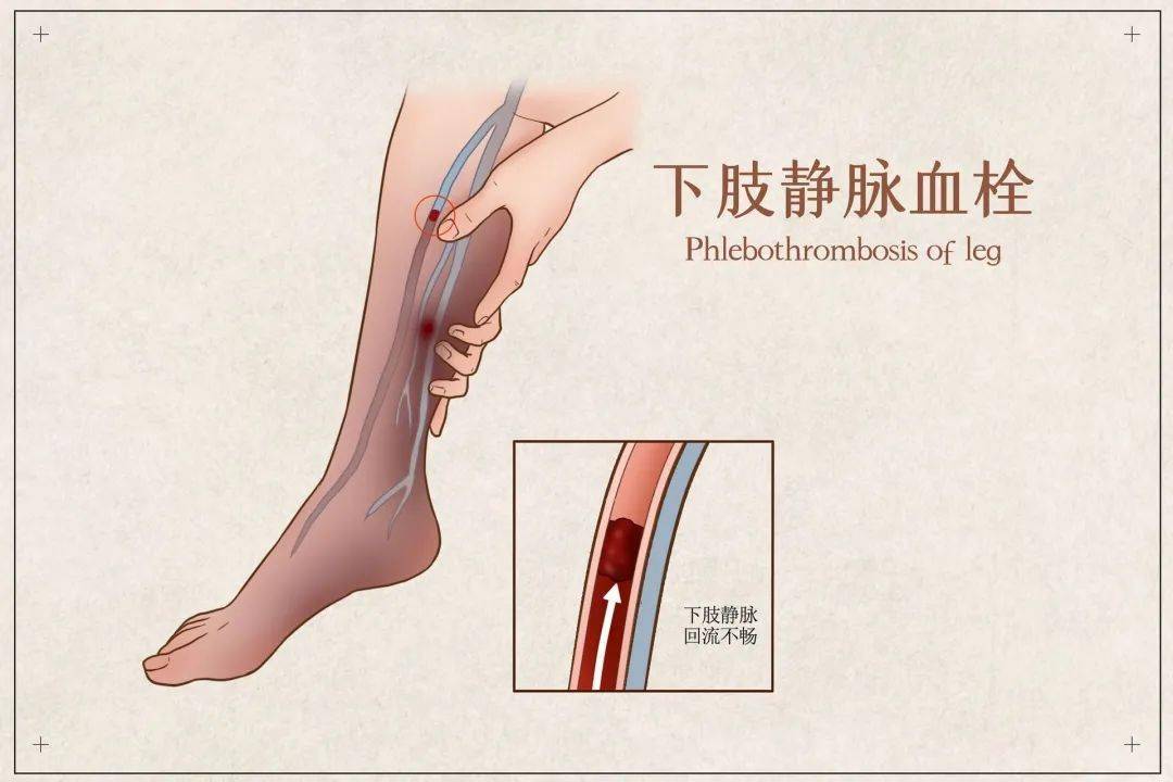 怎么治疗血栓：深度解析血栓形成机制及治疗方案